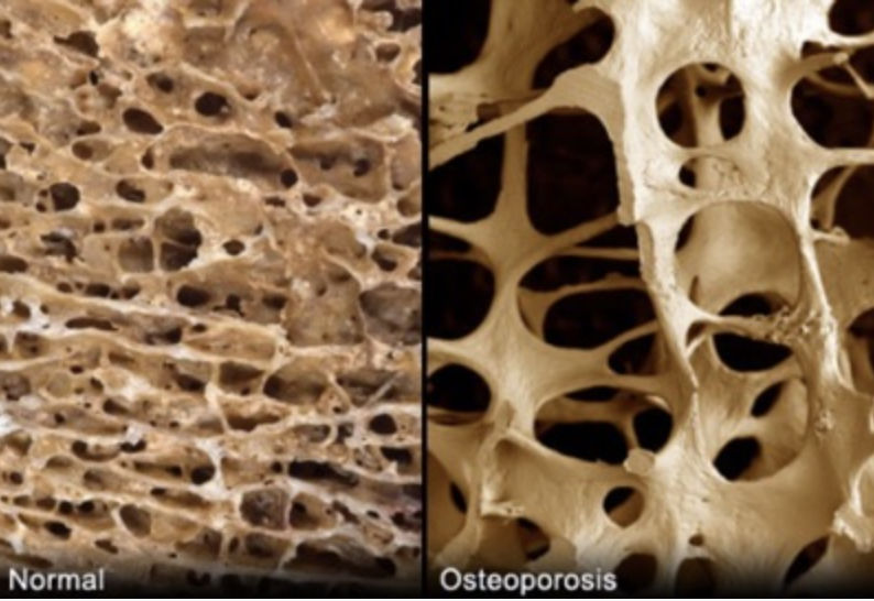 What is osteoporosis?